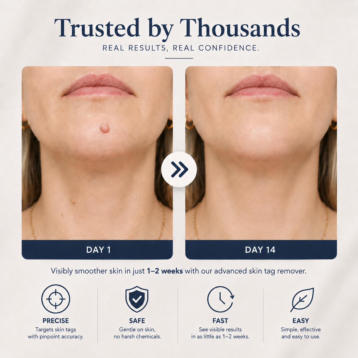 Diskret hemma-behandling av hudflikar och åldersvårtor med Skin Perfect kit — slipp klinikbesök